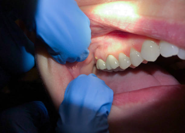 Best Emergency Dentist for Knocked-Out Tooth in Savage, MD